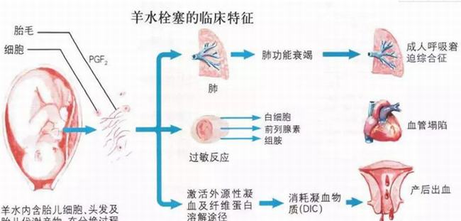 羊水栓塞是什么-羊水栓塞主要原因是什么(80%死亡率)