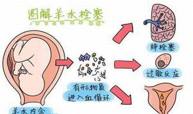 羊水栓塞是什么-羊水栓塞主要原因是什么(80%死亡率)